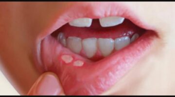 دون أدوية.. 3 طرق طبيعية وفعالة لعلاج قرح الفم – الجريدة