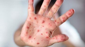 بعد ظهورها في الإمارات .. ما هي أعراض جدري القرود السلالة الجديدة؟ – الجريدة