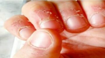 هل يسبب تقشر الجلد حول الأظافر ألما؟ قد يكون علامة على نقص الفيتامينات – الجريدة