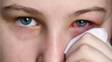 أمراض تصيب عينك في فصل الصيف أعرف أسبابها وأعراضها وعلاجها